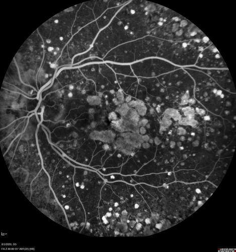 Age-related macular degeneration - Geographic Atrophy - Intermittent CME left eye from CRVO, Anemia, Diabetes
79 year old female - 3 years post CRVO in the left eye (20/32 VA) with intermittent CME.  Left eye is the better eye.  Vision is stable since 2 years ago
PMHx: Type II DM x 20 years, Chronic Anemia, Hyperlipidemia
VA 20/200 OD, 20/50 OS (usually 20/40)
