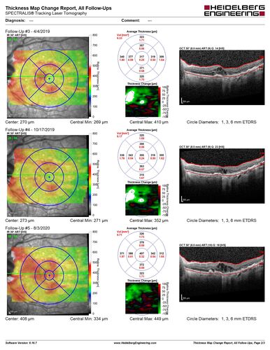 Age-related macular degeneration - Geographic Atrophy - Intermittent CME left eye from CRVO, Anemia, Diabetes
79 year old female - 3 years post CRVO in the left eye (20/32 VA) with intermittent CME.  Left eye is the better eye.  Vision is stable since 2 years ago
PMHx: Type II DM x 20 years, Chronic Anemia, Hyperlipidemia
VA 20/200 OD, 20/50 OS (usually 20/40)
