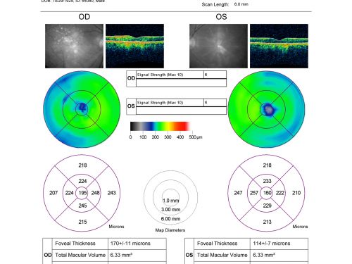 Non-Foveal Geographic Atrophy Both Eyes
81-year-old man has age-related macular degeneration in both eyes.  Vision OD is 20/40, OS is 20/80.
