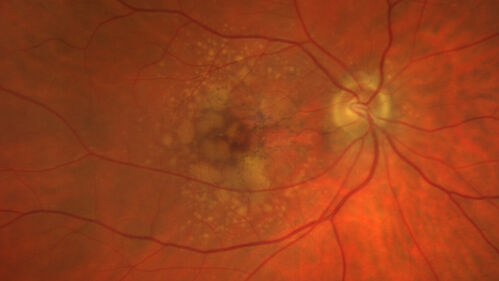 Dry AMD - Pigment - AREDS risk score of 4
65 year old woman with 20/32 vision.  A little blurred.  Pigment and large drusen in each eye.  AREDS risk score of four.
