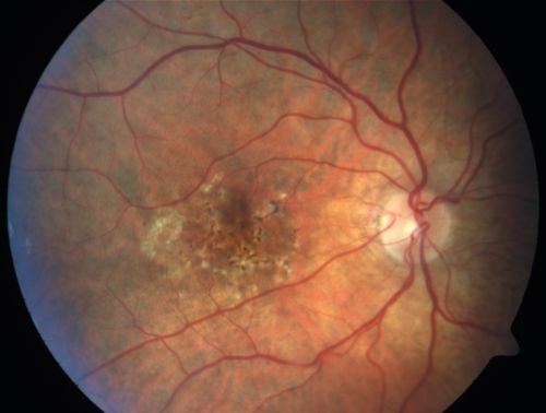 Hyperpigmentation of the Retinal Pigment Epithelium in Dry AMD
87-year-old woman has wet age-related macular degeneration in the left eye.    Vision OD is 20/25, OS is 20/400
