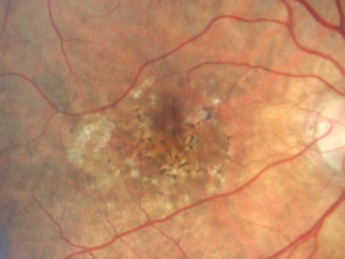Hyperpigmentation of Retinal Pigment Epithlium in Dry AMD (hyperplasia)
87-year-old woman has wet age-related macular degeneration in the left eye.  She had treatment up north but there has been a gap in therapy and the vision in the left eye is poor.  Vision OD is 20/25, OS is 20/400
