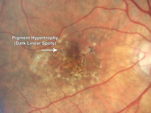 Hyperpigmentation of Retinal Pigment Epithlium in Dry AMD (hyperplasia)
87-year-old woman has wet age-related macular degeneration in the left eye.  She had treatment up north but there has been a gap in therapy and the vision in the left eye is poor.  Vision OD is 20/25, OS is 20/400
