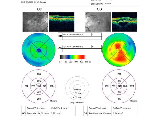 Hyperpigmentation of the Retinal Pigment Epithelium in Dry AMD
87-year-old woman has wet age-related macular degeneration in the left eye.    Vision OD is 20/25, OS is 20/400

