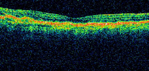 Hyperpigmentation of the Retinal Pigment Epithelium in Dry AMD
87-year-old woman has wet age-related macular degeneration in the left eye.    Vision OD is 20/25, OS is 20/400
