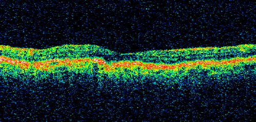Hyperpigmentation of Retinal Pigment Epithlium in Dry AMD (hyperplasia)
87-year-old woman has wet age-related macular degeneration in the left eye.  She had treatment up north but there has been a gap in therapy and the vision in the left eye is poor.  Vision OD is 20/25, OS is 20/400
