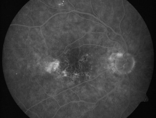 Hyperpigmentation of Retinal Pigment Epithlium in Dry AMD (hyperplasia)
87-year-old woman has wet age-related macular degeneration in the left eye.  She had treatment up north but there has been a gap in therapy and the vision in the left eye is poor.  Vision OD is 20/25, OS is 20/400
