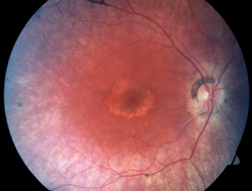 Cone-Rod Dystrophy 
34-year-old woman who is having some difficulty seeing at night, especially navigating through dark movie theaters and dark restaurants. OD is 20/30, OS is 20/30
Keywords: bulls eye;