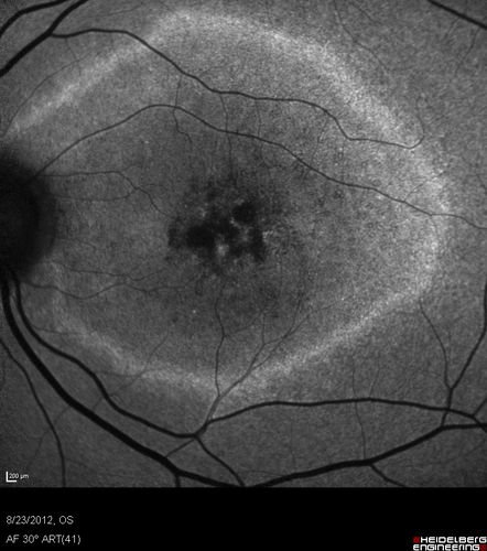 Macular possible Cone Dystrophy - Fundus Autofluorescence
