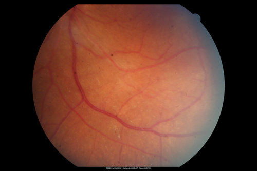 Retinitis Pigmentosa Sine Pigmento or Unknown Dystrophy - Peripheral Superficial White Spots and Recurrent CME
46-year-old woman three of her 5 siblings have been diagnosed with retinitis pigmentosa.  Her mother and father were seen and as far as everyone can tell, neither of them has it, although there was some thought they might be carriers.  They were evaluated twenty five years ago and since then as far as she knows, there has not been a lot of testing done.  

She has noticed a substantial decline in vision in both eyes over the last month or two.   OD 20/40,  OS 20/50.   IOP:  Both eyes have CME
