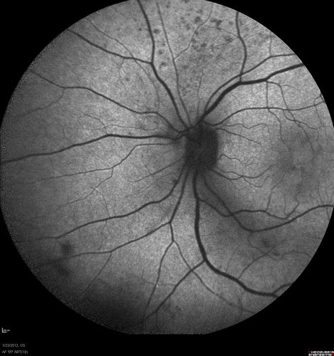 Retinitis Pigmentosa Sine Pigmento or Unknown Dystrophy - Peripheral Superficial White Spots and Recurrent CME - FAF
46-year-old woman three of her 5 siblings have been diagnosed with retinitis pigmentosa.  Her mother and father were seen and as far as everyone can tell, neither of them has it, although there was some thought they might be carriers.  They were evaluated twenty five years ago and since then as far as she knows, there has not been a lot of testing done.  

She has noticed a substantial decline in vision in both eyes over the last month or two.   OD 20/40,  OS 20/50.   IOP:  Both eyes have CME
