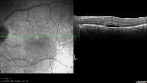 Retinitis Pigmentosa Sine Pigmento or Unknown Dystrophy - Peripheral Superficial White Spots and Recurrent CME
46-year-old woman three of her 5 siblings have been diagnosed with retinitis pigmentosa.  Her mother and father were seen and as far as everyone can tell, neither of them has it, although there was some thought they might be carriers.  They were evaluated twenty five years ago and since then as far as she knows, there has not been a lot of testing done.  

She has noticed a substantial decline in vision in both eyes over the last month or two.   OD 20/40,  OS 20/50.   IOP:  Both eyes have CME
