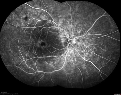Retinitis Pigmentosa Sine Pigmento or Unknown Dystrophy - Peripheral Superficial White Spots and Recurrent CME - FA Early
46-year-old woman three of her 5 siblings have been diagnosed with retinitis pigmentosa.  Her mother and father were seen and as far as everyone can tell, neither of them has it, although there was some thought they might be carriers.  They were evaluated twenty five years ago and since then as far as she knows, there has not been a lot of testing done.  

She has noticed a substantial decline in vision in both eyes over the last month or two.   OD 20/40,  OS 20/50.   IOP:  Both eyes have CME
