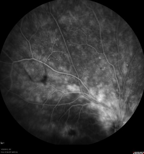 Retinitis Pigmentosa Sine Pigmento or Unknown Dystrophy - Peripheral Superficial White Spots and Recurrent CME - FA MID
46-year-old woman three of her 5 siblings have been diagnosed with retinitis pigmentosa.  Her mother and father were seen and as far as everyone can tell, neither of them has it, although there was some thought they might be carriers.  They were evaluated twenty five years ago and since then as far as she knows, there has not been a lot of testing done.  

She has noticed a substantial decline in vision in both eyes over the last month or two.   OD 20/40,  OS 20/50.   IOP:  Both eyes have CME
