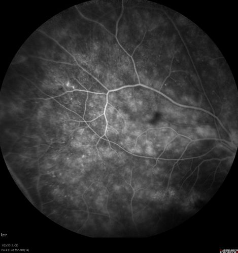 Retinitis Pigmentosa Sine Pigmento or Unknown Dystrophy - Peripheral Superficial White Spots and Recurrent CME - FA MID
46-year-old woman three of her 5 siblings have been diagnosed with retinitis pigmentosa.  Her mother and father were seen and as far as everyone can tell, neither of them has it, although there was some thought they might be carriers.  They were evaluated twenty five years ago and since then as far as she knows, there has not been a lot of testing done.  

She has noticed a substantial decline in vision in both eyes over the last month or two.   OD 20/40,  OS 20/50.   IOP:  Both eyes have CME
