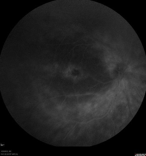 Retinitis Pigmentosa Sine Pigmento or Unknown Dystrophy - Peripheral Superficial White Spots and Recurrent CME- FA LATE
46-year-old woman three of her 5 siblings have been diagnosed with retinitis pigmentosa.  Her mother and father were seen and as far as everyone can tell, neither of them has it, although there was some thought they might be carriers.  They were evaluated twenty five years ago and since then as far as she knows, there has not been a lot of testing done.  

She has noticed a substantial decline in vision in both eyes over the last month or two.   OD 20/40,  OS 20/50.   IOP:  Both eyes have CME
