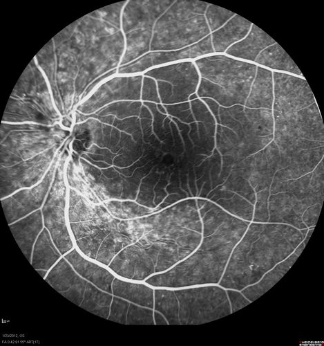Retinitis Pigmentosa Sine Pigmento or Unknown Dystrophy - Peripheral Superficial White Spots and Recurrent CME - FA Early
46-year-old woman three of her 5 siblings have been diagnosed with retinitis pigmentosa.  Her mother and father were seen and as far as everyone can tell, neither of them has it, although there was some thought they might be carriers.  They were evaluated twenty five years ago and since then as far as she knows, there has not been a lot of testing done.  

She has noticed a substantial decline in vision in both eyes over the last month or two.   OD 20/40,  OS 20/50.   IOP:  Both eyes have CME
