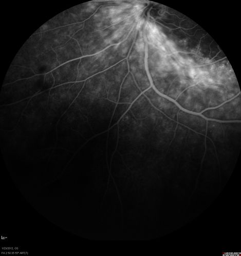 Retinitis Pigmentosa Sine Pigmento or Unknown Dystrophy - Peripheral Superficial White Spots and Recurrent CME
46-year-old woman three of her 5 siblings have been diagnosed with retinitis pigmentosa.  Her mother and father were seen and as far as everyone can tell, neither of them has it, although there was some thought they might be carriers.  They were evaluated twenty five years ago and since then as far as she knows, there has not been a lot of testing done.  

She has noticed a substantial decline in vision in both eyes over the last month or two.   OD 20/40,  OS 20/50.   IOP:  Both eyes have CME
