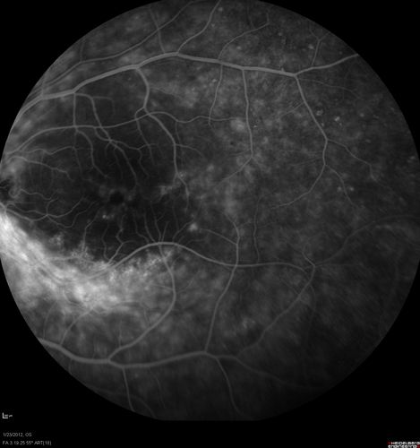 Retinitis Pigmentosa Sine Pigmento or Unknown Dystrophy - Peripheral Superficial White Spots and Recurrent CME
46-year-old woman three of her 5 siblings have been diagnosed with retinitis pigmentosa.  Her mother and father were seen and as far as everyone can tell, neither of them has it, although there was some thought they might be carriers.  They were evaluated twenty five years ago and since then as far as she knows, there has not been a lot of testing done.  

She has noticed a substantial decline in vision in both eyes over the last month or two.   OD 20/40,  OS 20/50.   IOP:  Both eyes have CME
