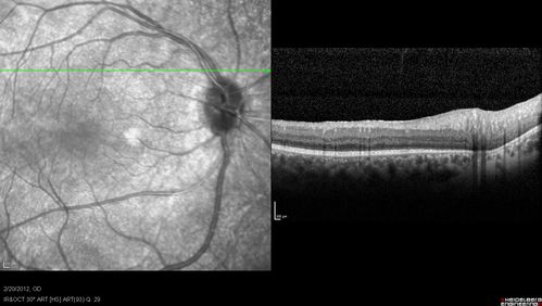 Retinitis Pigmentosa Sine Pigmento or Unknown Dystrophy - Peripheral Superficial White Spots and Recurrent CME
1 month of treatment with diamox 500 mg BID- cme is a little better
