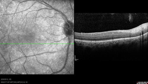 Retinitis Pigmentosa Sine Pigmento or Unknown Dystrophy - Peripheral Superficial White Spots and Recurrent CME
1 month of treatment with diamox 500 mg BID- cme is a little better
