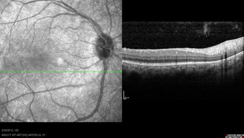 Retinitis Pigmentosa Sine Pigmento or Unknown Dystrophy - Peripheral Superficial White Spots and Recurrent CME
1 month of treatment with diamox 500 mg BID- cme is a little better

