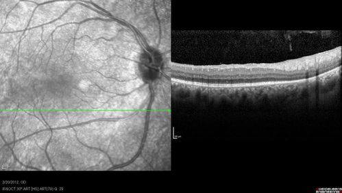 Retinitis Pigmentosa Sine Pigmento or Unknown Dystrophy - Peripheral Superficial White Spots and Recurrent CME
1 month of treatment with diamox 500 mg BID- cme is a little better
