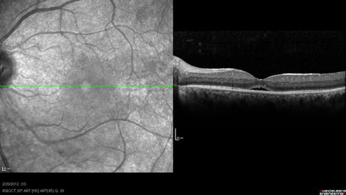 Retinitis Pigmentosa Sine Pigmento or Unknown Dystrophy - Peripheral Superficial White Spots and Recurrent CME
1 month of treatment with diamox 500 mg BID- cme is a little better
