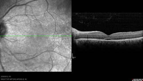 Retinitis Pigmentosa Sine Pigmento or Unknown Dystrophy - Peripheral Superficial White Spots and Recurrent CME
1 month of treatment with diamox 500 mg BID- cme is a little better
