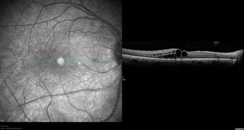 Retinitis Pigmentosa Sine Pigmento or Unknown Dystrophy - Peripheral Superficial White Spots and Recurrent CME
CME worse - patient received subtenon's kenalog injection right eye.
