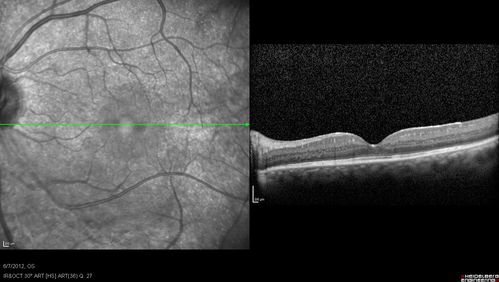 Retinitis Pigmentosa Sine Pigmento or Unknown Dystrophy - Peripheral Superficial White Spots and Recurrent CME
CME worse - patient received subtenon's kenalog injection right eye.

