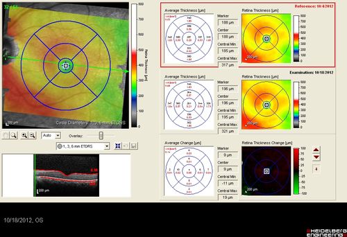 Retinitis Pigmentosa Sine Pigmento or Unknown Dystrophy - Peripheral Superficial White Spots and Recurrent CME
Comparison of Maps - CME is now cleared
