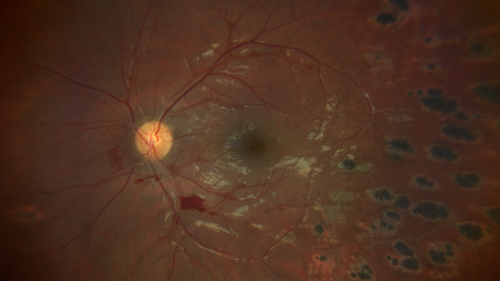 Eales Disease and fresh vitreous hemorrhage - 20 year old man
20 year old mane with fresh vitreous hemorrhage in the right eye.  At age 15 he had a PPV and laser in the left eye and laser in the right eye.  The vision is OD 20/80 PH 20/25, OS 20/25.  The left eye has a mild cataract.  He had prior testing for coagulopathies which was negative.  Testing done for syphillis and TB was negative.  Additional laser was done to prevent further bleeding in the right eye.

