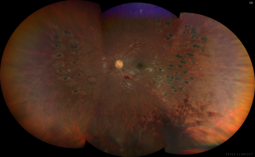 Eales Disease and fresh vitreous hemorrhage - 20 year old man
20 year old mane with fresh vitreous hemorrhage in the right eye.  At age 15 he had a PPV and laser in the left eye and laser in the right eye.  The vision is OD 20/80 PH 20/25, OS 20/25.  The left eye has a mild cataract.  He had prior testing for coagulopathies which was negative.  Testing done for syphillis and TB was negative.  Additional laser was done to prevent further bleeding in the right eye.
