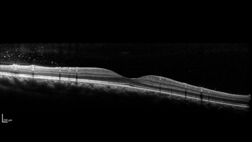 Eales Disease and fresh vitreous hemorrhage - 20 year old man
20 year old mane with fresh vitreous hemorrhage in the right eye.  At age 15 he had a PPV and laser in the left eye and laser in the right eye.  The vision is OD 20/80 PH 20/25, OS 20/25.  The left eye has a mild cataract.  He had prior testing for coagulopathies which was negative.  Testing done for syphillis and TB was negative.  Additional laser was done to prevent further bleeding in the right eye.
