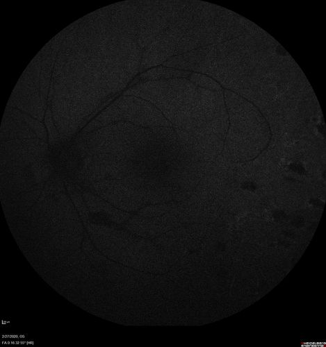 Eales Disease and fresh vitreous hemorrhage - 20 year old man
20 year old mane with fresh vitreous hemorrhage in the right eye.  At age 15 he had a PPV and laser in the left eye and laser in the right eye.  The vision is OD 20/80 PH 20/25, OS 20/25.  The left eye has a mild cataract.  He had prior testing for coagulopathies which was negative.  Testing done for syphillis and TB was negative.  Additional laser was done to prevent further bleeding in the right eye.
