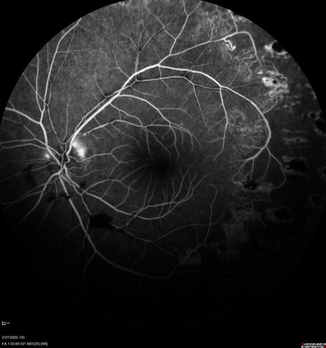 Eales Disease and fresh vitreous hemorrhage - 20 year old man
20 year old mane with fresh vitreous hemorrhage in the right eye.  At age 15 he had a PPV and laser in the left eye and laser in the right eye.  The vision is OD 20/80 PH 20/25, OS 20/25.  The left eye has a mild cataract.  He had prior testing for coagulopathies which was negative.  Testing done for syphillis and TB was negative.  Additional laser was done to prevent further bleeding in the right eye.

