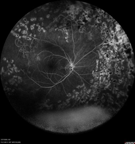 Eales Disease and fresh vitreous hemorrhage - 20 year old man
20 year old mane with fresh vitreous hemorrhage in the right eye.  At age 15 he had a PPV and laser in the left eye and laser in the right eye.  The vision is OD 20/80 PH 20/25, OS 20/25.  The left eye has a mild cataract.  He had prior testing for coagulopathies which was negative.  Testing done for syphillis and TB was negative.  Additional laser was done to prevent further bleeding in the right eye.
