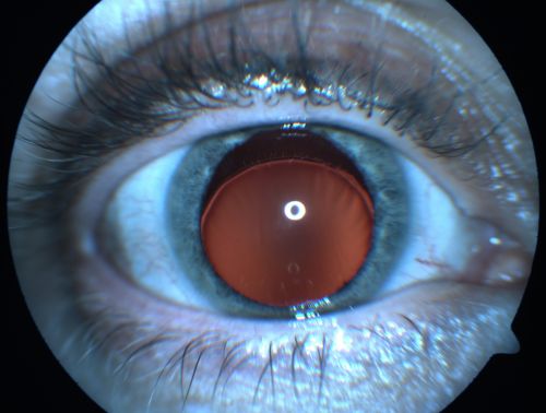 Ectopia Lentis - Marfan's Syndrome - Intermittent Pupillary Block Glaucoma Right Eye
41-year-old woman decreased vision right eye and intermittent pupillary block glaucoma for 6 months from a dislocated natural lens in the eye, probably associated with Marfan syndrome.Vision OD is 20/160, PH 20/40; OS is 20/30, PH 20/25
