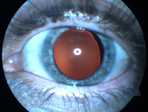 Ectopia Lentis - Marfan's Syndrome - Intermittent Pupillary Block Glaucoma Right Eye
41-year-old woman decreased vision right eye and intermittent pupillary block glaucoma for 6 months from a dislocated natural lens in the eye, probably associated with Marfan syndrome.Vision OD is 20/160, PH 20/40; OS is 20/30, PH 20/25
