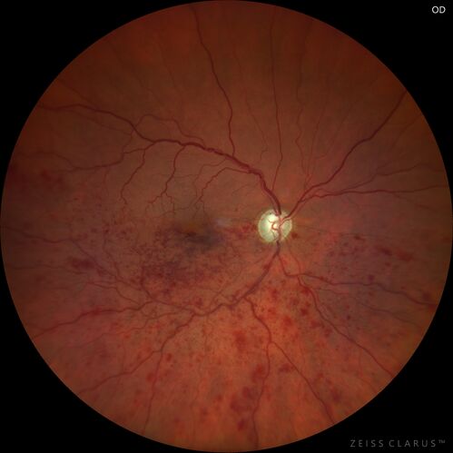 Branch Retinal Vein Occlusion and worsened cystoid macular edema following cataract surgery
51 year old female The patient noticed gradual vision loss in both eyes starting possibly after her last cataract surgery in May of 2022 (3 months ago). She had ECCE 3/2022 OD and 5/2022 OS.  She does not have diabetes. She had glaucoma shunts placed about 2017.  She has been on latanoprost and timolol.  She is now getting ready to start Combigan and Bromfenac.  She is also staring xidra for dry eye.  She stopped the latanorpost on 8/15/22.  She has had macular edema before for which she had intraocular injections which worked.  She has had no injections lately. When she was getting treated for macular edema in the past she had an IOP of 60. 
Medical Hx: Hypertension, Systemic. Glaucoma. Arthritis. Vertigo. Stroke. 
Systemic Meds: Trimfya. NAPROXEN. LISINOPRIL. 
VA OD: sc20/63-1 
VA OS: sc20/50 
IOP: TP: OD:12 OS:12
