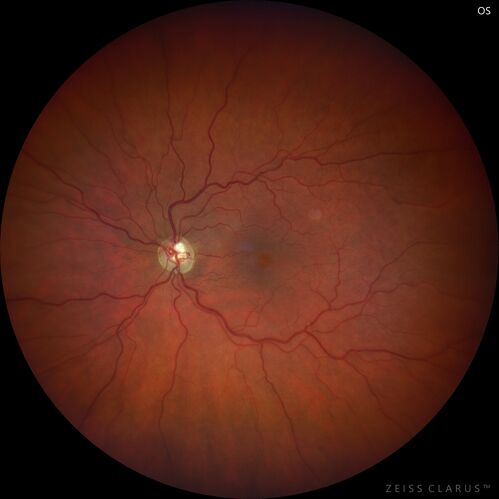Branch Retinal Vein Occlusion and worsened cystoid macular edema following cataract surgery
51 year old female The patient noticed gradual vision loss in both eyes starting possibly after her last cataract surgery in May of 2022 (3 months ago). She had ECCE 3/2022 OD and 5/2022 OS.  She does not have diabetes. She had glaucoma shunts placed about 2017.  She has been on latanoprost and timolol.  She is now getting ready to start Combigan and Bromfenac.  She is also staring xidra for dry eye.  She stopped the latanorpost on 8/15/22.  She has had macular edema before for which she had intraocular injections which worked.  She has had no injections lately. When she was getting treated for macular edema in the past she had an IOP of 60. 
Medical Hx: Hypertension, Systemic. Glaucoma. Arthritis. Vertigo. Stroke. 
Systemic Meds: Trimfya. NAPROXEN. LISINOPRIL. 
VA OD: sc20/63-1 
VA OS: sc20/50 
IOP: TP: OD:12 OS:12
