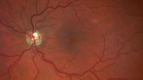 Branch Retinal Vein Occlusion and worsened cystoid macular edema following cataract surgery
51 year old female The patient noticed gradual vision loss in both eyes starting possibly after her last cataract surgery in May of 2022 (3 months ago). She had ECCE 3/2022 OD and 5/2022 OS.  She does not have diabetes. She had glaucoma shunts placed about 2017.  She has been on latanoprost and timolol.  She is now getting ready to start Combigan and Bromfenac.  She is also staring xidra for dry eye.  She stopped the latanorpost on 8/15/22.  She has had macular edema before for which she had intraocular injections which worked.  She has had no injections lately. When she was getting treated for macular edema in the past she had an IOP of 60. 
Medical Hx: Hypertension, Systemic. Glaucoma. Arthritis. Vertigo. Stroke. 
Systemic Meds: Trimfya. NAPROXEN. LISINOPRIL. 
VA OD: sc20/63-1 
VA OS: sc20/50 
IOP: TP: OD:12 OS:12

