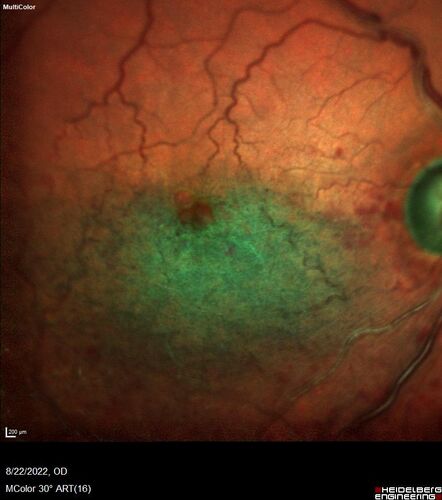 Branch Retinal Vein Occlusion and worsened cystoid macular edema following cataract surgery
51 year old female The patient noticed gradual vision loss in both eyes starting possibly after her last cataract surgery in May of 2022 (3 months ago). She had ECCE 3/2022 OD and 5/2022 OS.  She does not have diabetes. She had glaucoma shunts placed about 2017.  She has been on latanoprost and timolol.  She is now getting ready to start Combigan and Bromfenac.  She is also staring xidra for dry eye.  She stopped the latanorpost on 8/15/22.  She has had macular edema before for which she had intraocular injections which worked.  She has had no injections lately. When she was getting treated for macular edema in the past she had an IOP of 60. 
Medical Hx: Hypertension, Systemic. Glaucoma. Arthritis. Vertigo. Stroke. 
Systemic Meds: Trimfya. NAPROXEN. LISINOPRIL. 
VA OD: sc20/63-1 
VA OS: sc20/50 
IOP: TP: OD:12 OS:12
