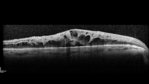 Branch Retinal Vein Occlusion and worsened cystoid macular edema following cataract surgery
51 year old female The patient noticed gradual vision loss in both eyes starting possibly after her last cataract surgery in May of 2022 (3 months ago). She had ECCE 3/2022 OD and 5/2022 OS.  She does not have diabetes. She had glaucoma shunts placed about 2017.  She has been on latanoprost and timolol.  She is now getting ready to start Combigan and Bromfenac.  She is also staring xidra for dry eye.  She stopped the latanorpost on 8/15/22.  She has had macular edema before for which she had intraocular injections which worked.  She has had no injections lately. When she was getting treated for macular edema in the past she had an IOP of 60. 
Medical Hx: Hypertension, Systemic. Glaucoma. Arthritis. Vertigo. Stroke. 
Systemic Meds: Trimfya. NAPROXEN. LISINOPRIL. 
VA OD: sc20/63-1 
VA OS: sc20/50 
IOP: TP: OD:12 OS:12

