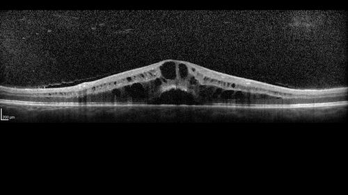 Branch Retinal Vein Occlusion and worsened cystoid macular edema following cataract surgery
51 year old female The patient noticed gradual vision loss in both eyes starting possibly after her last cataract surgery in May of 2022 (3 months ago). She had ECCE 3/2022 OD and 5/2022 OS.  She does not have diabetes. She had glaucoma shunts placed about 2017.  She has been on latanoprost and timolol.  She is now getting ready to start Combigan and Bromfenac.  She is also staring xidra for dry eye.  She stopped the latanorpost on 8/15/22.  She has had macular edema before for which she had intraocular injections which worked.  She has had no injections lately. When she was getting treated for macular edema in the past she had an IOP of 60. 
Medical Hx: Hypertension, Systemic. Glaucoma. Arthritis. Vertigo. Stroke. 
Systemic Meds: Trimfya. NAPROXEN. LISINOPRIL. 
VA OD: sc20/63-1 
VA OS: sc20/50 
IOP: TP: OD:12 OS:12
