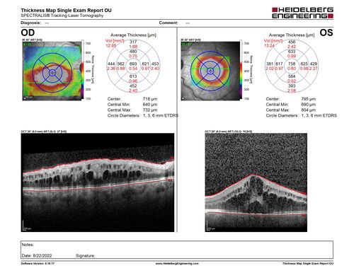 Branch Retinal Vein Occlusion and worsened cystoid macular edema following cataract surgery
51 year old female The patient noticed gradual vision loss in both eyes starting possibly after her last cataract surgery in May of 2022 (3 months ago). She had ECCE 3/2022 OD and 5/2022 OS.  She does not have diabetes. She had glaucoma shunts placed about 2017.  She has been on latanoprost and timolol.  She is now getting ready to start Combigan and Bromfenac.  She is also staring xidra for dry eye.  She stopped the latanorpost on 8/15/22.  She has had macular edema before for which she had intraocular injections which worked.  She has had no injections lately. When she was getting treated for macular edema in the past she had an IOP of 60. 
Medical Hx: Hypertension, Systemic. Glaucoma. Arthritis. Vertigo. Stroke. 
Systemic Meds: Trimfya. NAPROXEN. LISINOPRIL. 
VA OD: sc20/63-1 
VA OS: sc20/50 
IOP: TP: OD:12 OS:12

