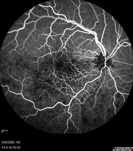 Branch Retinal Vein Occlusion and worsened cystoid macular edema following cataract surgery
51 year old female The patient noticed gradual vision loss in both eyes starting possibly after her last cataract surgery in May of 2022 (3 months ago). She had ECCE 3/2022 OD and 5/2022 OS.  She does not have diabetes. She had glaucoma shunts placed about 2017.  She has been on latanoprost and timolol.  She is now getting ready to start Combigan and Bromfenac.  She is also staring xidra for dry eye.  She stopped the latanorpost on 8/15/22.  She has had macular edema before for which she had intraocular injections which worked.  She has had no injections lately. When she was getting treated for macular edema in the past she had an IOP of 60. 
Medical Hx: Hypertension, Systemic. Glaucoma. Arthritis. Vertigo. Stroke. 
Systemic Meds: Trimfya. NAPROXEN. LISINOPRIL. 
VA OD: sc20/63-1 
VA OS: sc20/50 
IOP: TP: OD:12 OS:12
