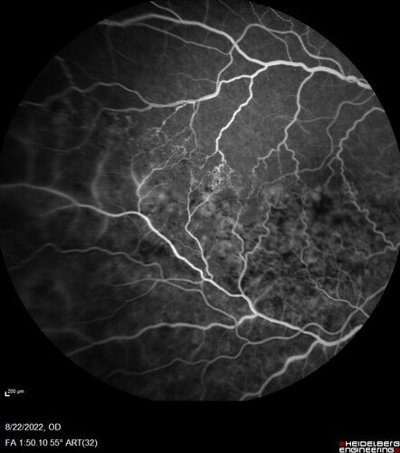 Branch Retinal Vein Occlusion and worsened cystoid macular edema following cataract surgery
51 year old female The patient noticed gradual vision loss in both eyes starting possibly after her last cataract surgery in May of 2022 (3 months ago). She had ECCE 3/2022 OD and 5/2022 OS.  She does not have diabetes. She had glaucoma shunts placed about 2017.  She has been on latanoprost and timolol.  She is now getting ready to start Combigan and Bromfenac.  She is also staring xidra for dry eye.  She stopped the latanorpost on 8/15/22.  She has had macular edema before for which she had intraocular injections which worked.  She has had no injections lately. When she was getting treated for macular edema in the past she had an IOP of 60. 
Medical Hx: Hypertension, Systemic. Glaucoma. Arthritis. Vertigo. Stroke. 
Systemic Meds: Trimfya. NAPROXEN. LISINOPRIL. 
VA OD: sc20/63-1 
VA OS: sc20/50 
IOP: TP: OD:12 OS:12
