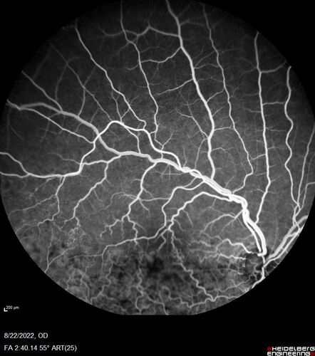 Branch Retinal Vein Occlusion and worsened cystoid macular edema following cataract surgery
51 year old female The patient noticed gradual vision loss in both eyes starting possibly after her last cataract surgery in May of 2022 (3 months ago). She had ECCE 3/2022 OD and 5/2022 OS.  She does not have diabetes. She had glaucoma shunts placed about 2017.  She has been on latanoprost and timolol.  She is now getting ready to start Combigan and Bromfenac.  She is also staring xidra for dry eye.  She stopped the latanorpost on 8/15/22.  She has had macular edema before for which she had intraocular injections which worked.  She has had no injections lately. When she was getting treated for macular edema in the past she had an IOP of 60. 
Medical Hx: Hypertension, Systemic. Glaucoma. Arthritis. Vertigo. Stroke. 
Systemic Meds: Trimfya. NAPROXEN. LISINOPRIL. 
VA OD: sc20/63-1 
VA OS: sc20/50 
IOP: TP: OD:12 OS:12
